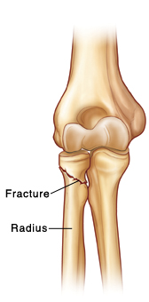 Elbow joint showing fracture near the end of the radius close to the elbow.