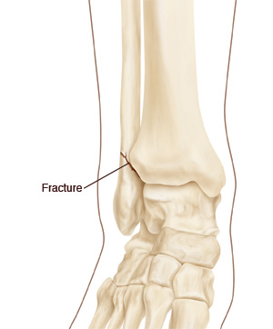 Image showing a fracture in an ankle bone.