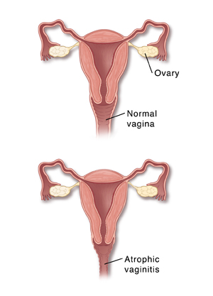 Normal vagina compared to vagina with atrophic vaginitis.