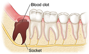 Lower jaw showing teeth and empty socket with blood clot.