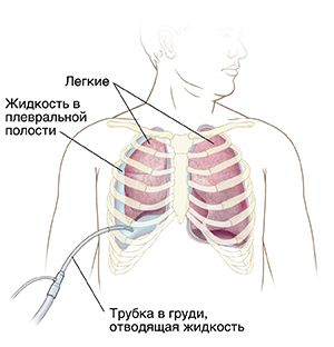 Вид спереди на грудную клетку мужчины с изображением трубки, отводящей жидкость из пространства рядом с легким.