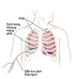 Mặt trước ngực của người đàn ông cho thấy ống dẫn lưu dịch từ khoang bên cạnh phổi.