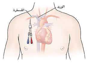 صورة توضيحية لصدر رجل تُظهر القلب والرئتين إلى جانب خط مركزي مثبت في مكانه المناسب.