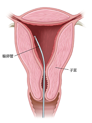 子宮頸橫截面與子宮內膜活檢管。