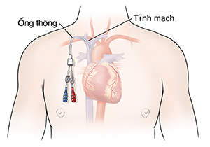 Phác thảo ngực của người đàn ông cho thấy tim có đặt đường truyền trung tâm.