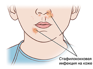 Нижняя часть лица и шея крупным планом. Стафилококковые язвы на носу и возле рта.