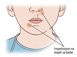 Malapitang kuha ng ibabang mukha at leeg. Nagsusugat ang impeksyong sanhi ng staphilococcus sa ilong at malapit sa bibig.