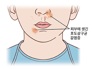 얼굴 아랫부분과 목 근접 모습. 코와 입 부근에 생긴 포도상구균 감염 상처.