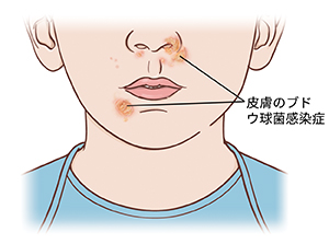 顔の下部と首の拡大図。ブドウ球菌感染症では、鼻と口の近くに痛みが現れます。