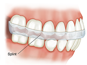 Side view of teeth showing splint in place.