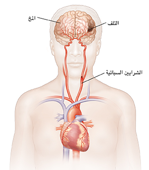 صورة أمامية للرأس والجزء العلوي من الجسم تُظهر القلب، والشرايين السباتية، وتلف في المخ.