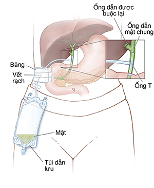 Mặt trước của thân trên cho thấy gan, dạ dày và tuyến tụy có gắn ống t và túi để dẫn lưu. Hình nhỏ cho thấy hình cận cảnh của ống t trong ống dẫn mật.
